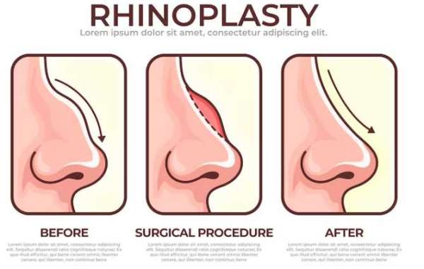 Neck Lift in Houston: Achieving a Youthful Profile through Cosmetic Surgery